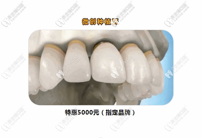 晉江維樂(lè)口腔開診期間做韓國(guó)登騰種植牙價(jià)格只需5000元起嘍!