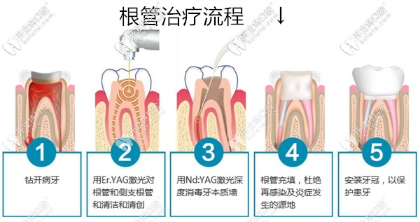 根管治療的流程圖