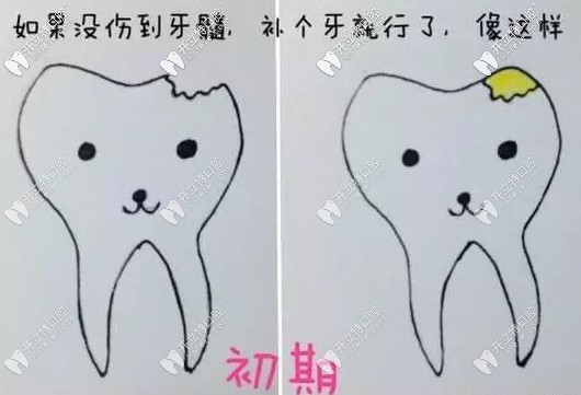 沒傷到牙髓只需補(bǔ)牙不要隨便做根管治療