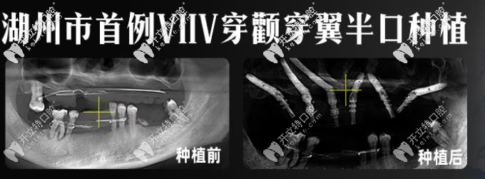 穿顴穿翼種植牙技術(shù)