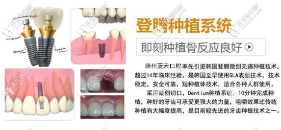 登騰種植體的特點(diǎn) 登騰種植體的特點(diǎn)