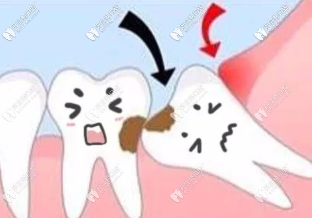 智齒不拔有什么危害嗎