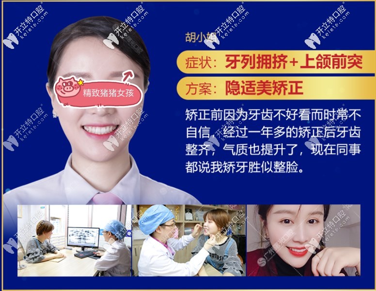 隱適美矯正案例