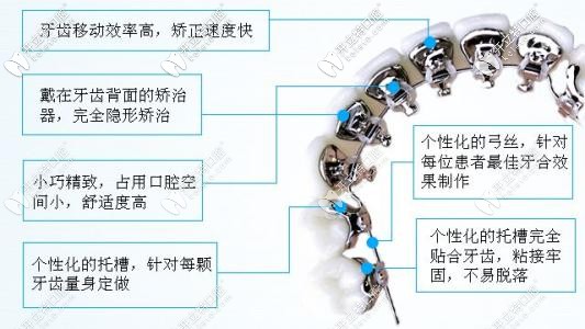 舌側矯正優(yōu)勢