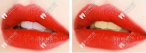 黃牙與白牙的效果對(duì)比圖