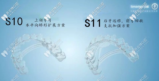 S10、S11牙弓重塑隱形技術(shù)