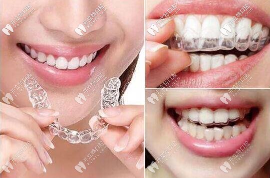 全隱形無托槽矯治器