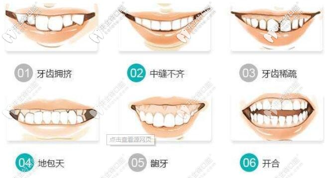 各種牙齒不齊問題都可矯治 各種牙齒不齊問題都可矯治