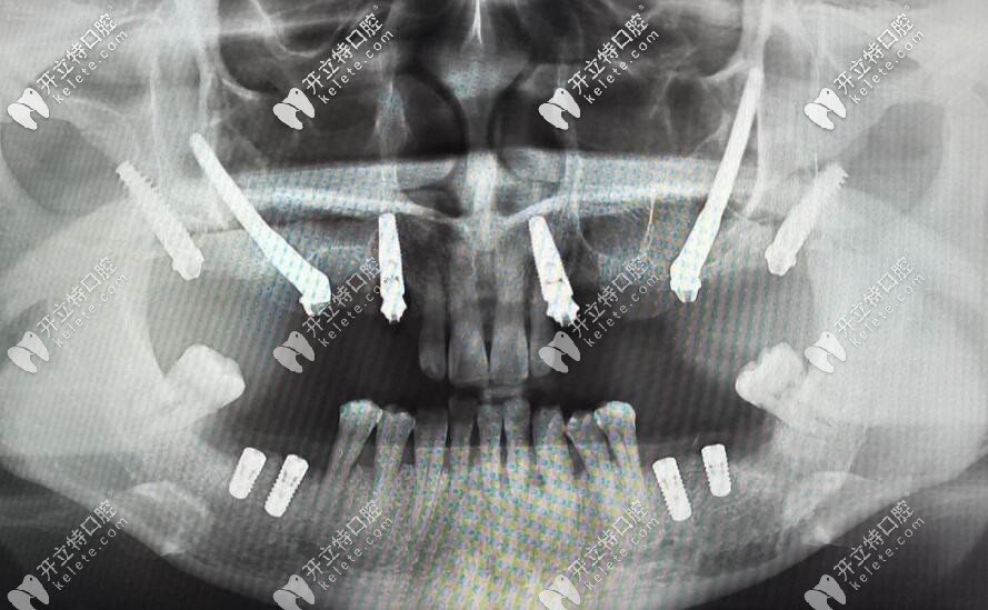 穿顴穿翼種植牙技術(shù)