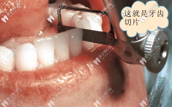 我的正畸方案是牙齒切片后戴牙套