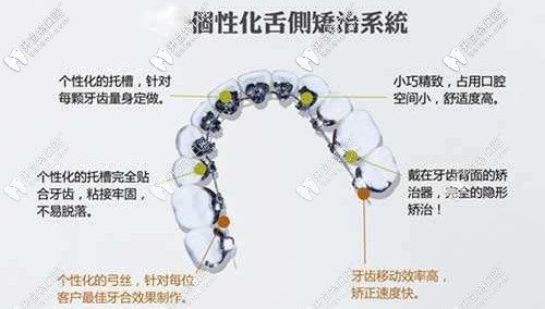 個性化舌側(cè)矯正系統(tǒng)的特點(diǎn)