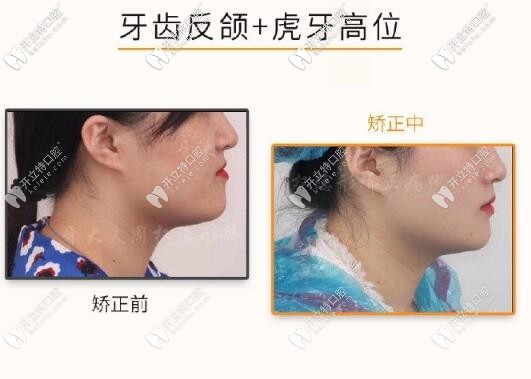 長沙周權醫(yī)生牙齒矯正案例