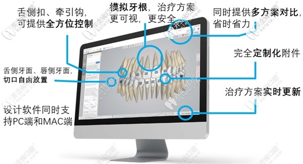 Spark精靚隱形矯治系統(tǒng)的控根技術(shù)介紹