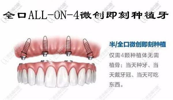 廈門allon4全口微創(chuàng)即刻負(fù)重種植牙價格