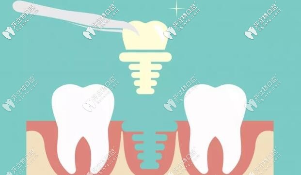 種植牙選哪個(gè)好