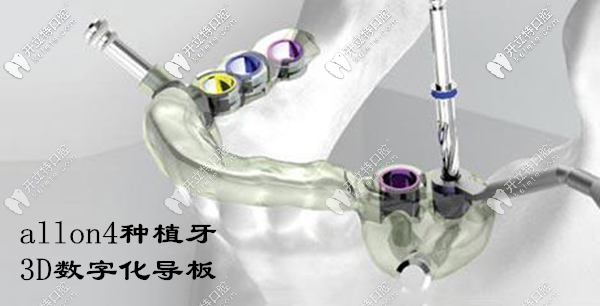 廈門種植全口牙的費(fèi)用