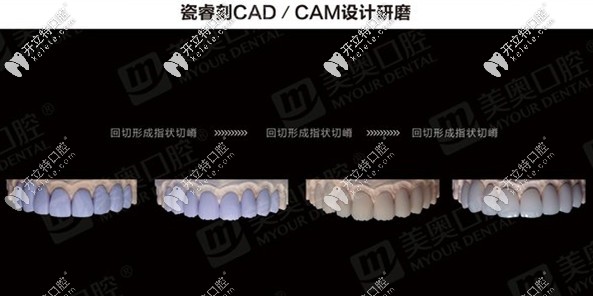 瓷?？藽AD/CAM設(shè)計