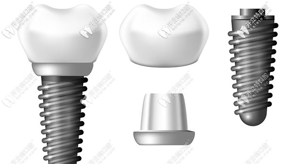 瑞典諾貝爾cc種植牙價格及使用壽命