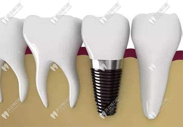 德國(guó)瑞西歐種植體優(yōu)勢(shì)