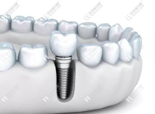 德國(guó)瑞西歐種植體