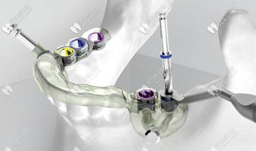 3D數(shù)字化導(dǎo)板種植技術(shù)