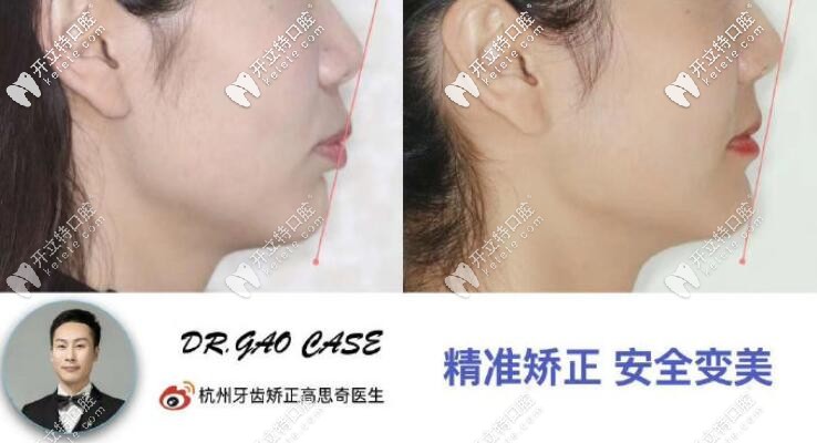 剛整理的杭州美奧口腔凸嘴齙牙矯正案例及收費價格