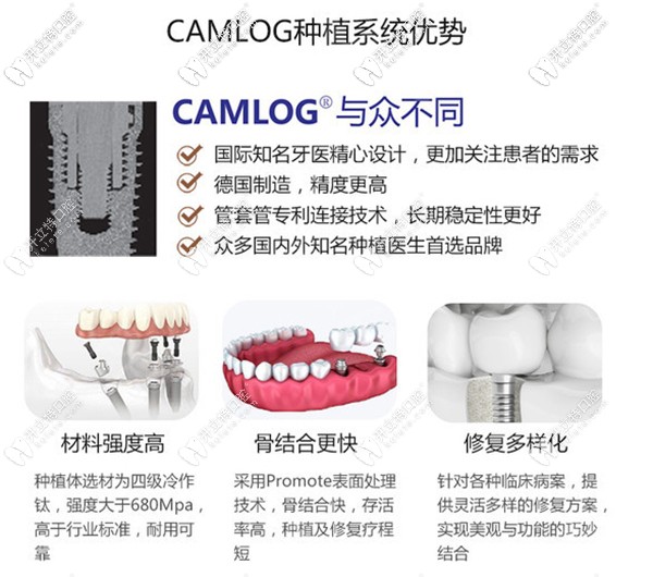 德國(guó)camlog種植體有哪些優(yōu)點(diǎn)