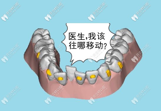 牙齒矯正時(shí)移動(dòng)軌跡