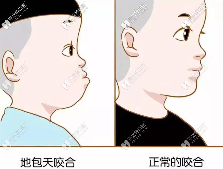 孩子牙齒地包天要盡早矯正
