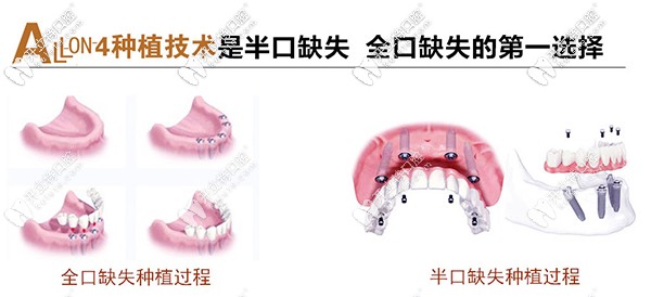 北京市朝陽(yáng)區(qū)維樂(lè)做allon4速導(dǎo)半口種植牙價(jià)格是多少？