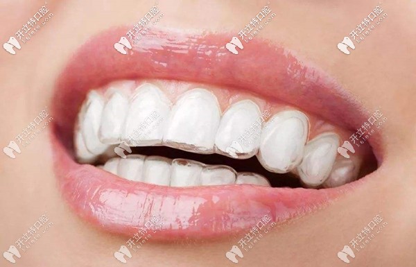 活動(dòng)期間訂購正雅隱形矯正可免方案和取模費(fèi) 活動(dòng)期間訂購正雅隱形矯正可免方案和取模費(fèi)