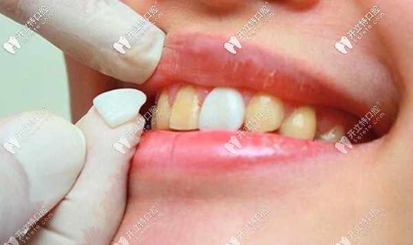 <!--<i data=20240703-sp></i>-->的牙齒貼面也有特價(jià) <!--<i data=20240703-sp></i>-->的牙齒貼面也有特價(jià)