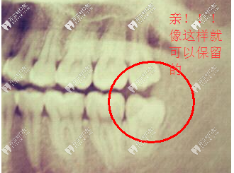 比較正的智齒不用拔除