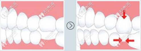 缺牙久了鄰牙也會受到影響