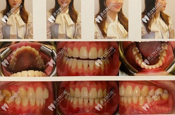 整牙的時(shí)間不長，但是<span style=
