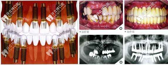 滿口種植牙大概要多少錢