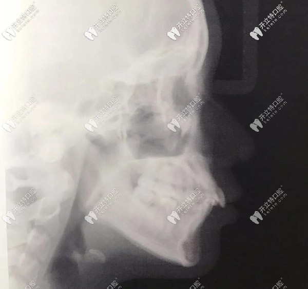 側(cè)面X光，門牙唇傾很厲害的