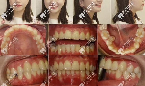 正面、側(cè)面照，記錄牙齒的變化情況