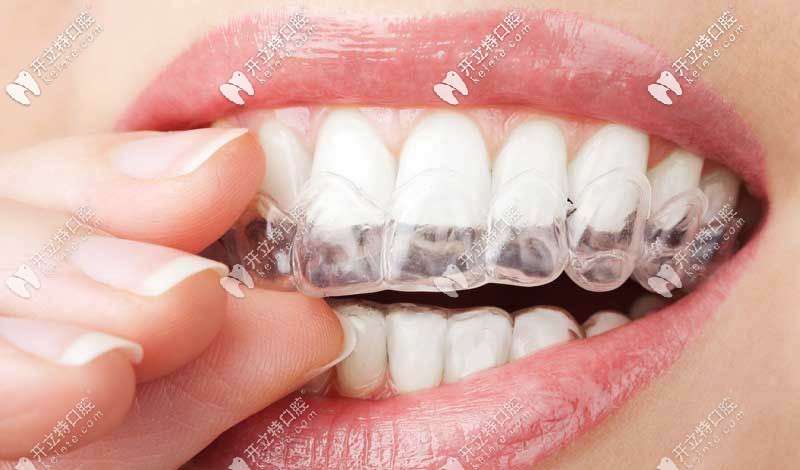 天水市全隱形矯正 天水市全隱形矯正