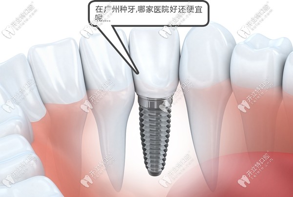 關于廣州哪家醫(yī)院做種植牙的價格便宜又好,都在此攻略
