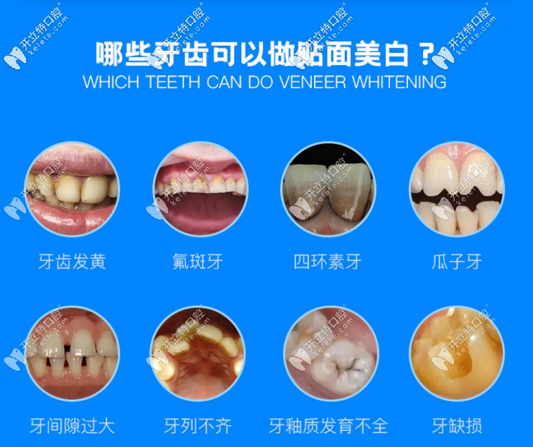 哪些牙適合做貼面美白 哪些牙適合做貼面美白