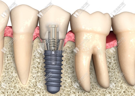 廣州廣州穗華口腔的種植牙價(jià)格