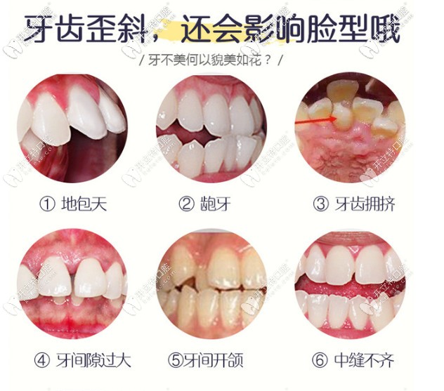 牙齒不齊的類型 牙齒不齊的類型