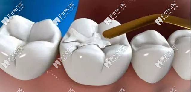 窩溝充填 窩溝充填