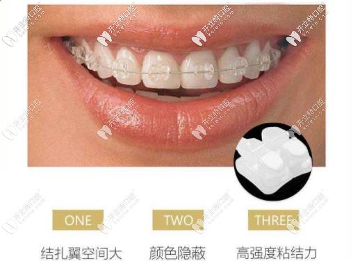 半隱形矯正特色 半隱形矯正特色