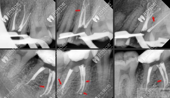 根管治療的拍片圖