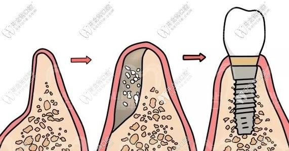 種植牙植骨粉示意圖 種植牙植骨粉示意圖