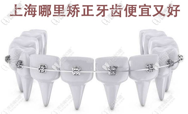 上海哪里矯正牙齒便宜又好，這些有名的牙科醫(yī)院值得選擇
