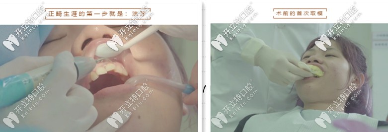 做牙齒矯正檢查項目