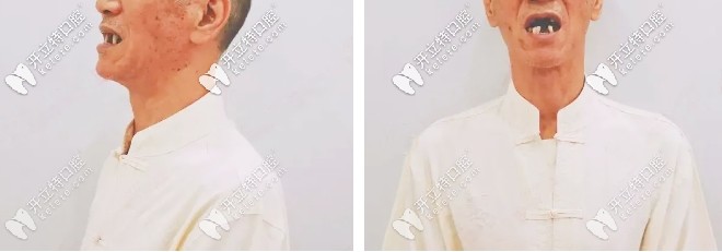 80歲老人在廣州越秀區(qū)做瑞典諾貝爾種植牙的真實感受